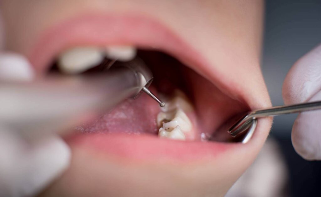Root Canal Treatment