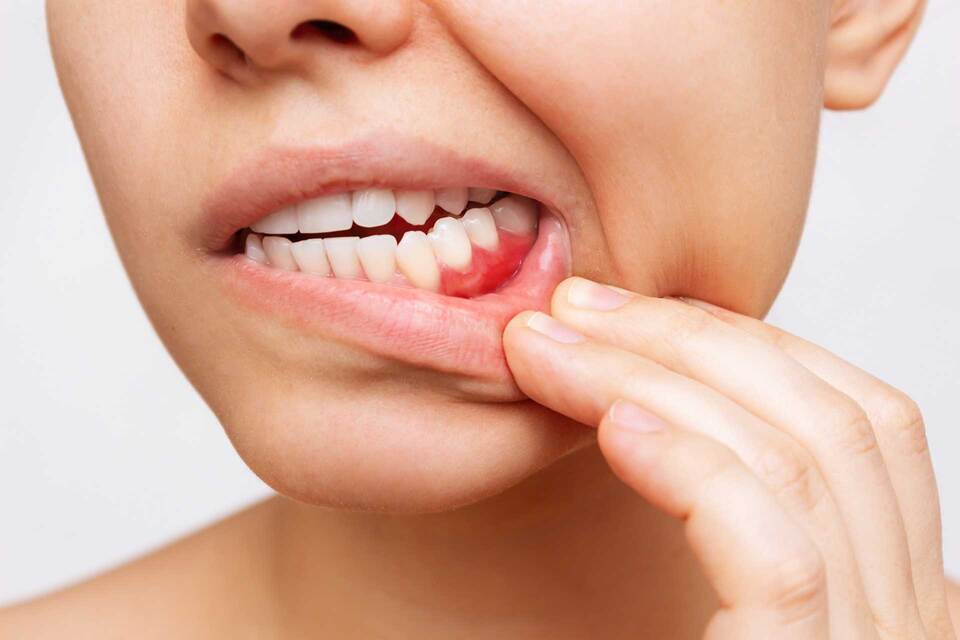 Gum Diseases
